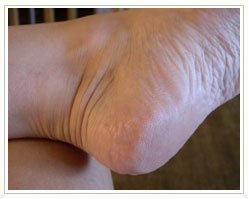 Slider image (7) Laser Foot Surgery Specialist | Spanish Patient Center